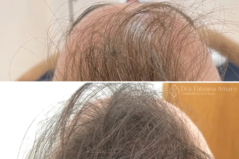 Antes e depois de terapia capilar, paciente 1