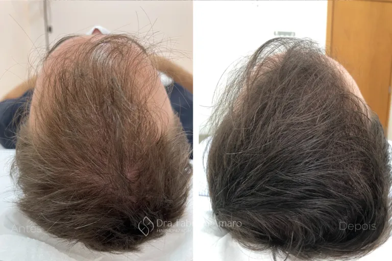 Antes e depois de terapia capilar, paciente 2