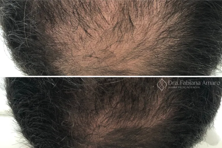 Antes e depois de terapia capilar, paciente 3