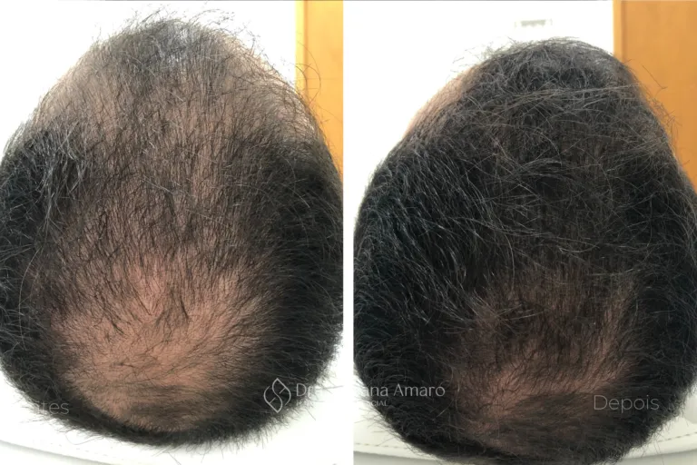 Antes e depois de terapia capilar, paciente 4