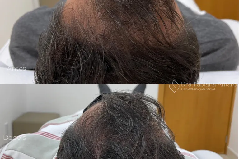 Antes e depois de terapia capilar, paciente 5