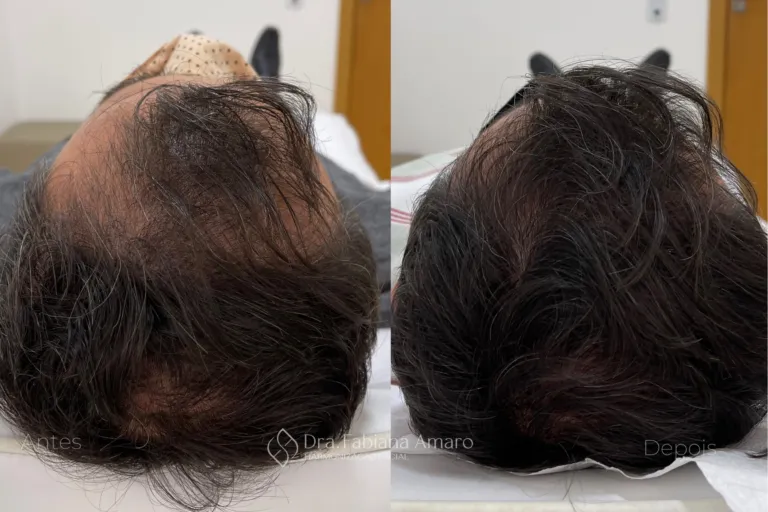 Antes e depois de terapia capilar, paciente 6