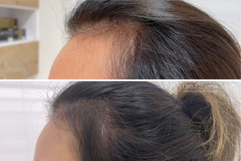 Antes e depois de terapia capilar, paciente 7